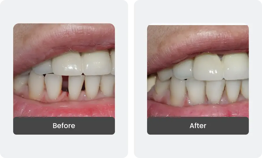 Before and After