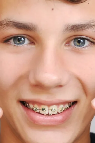 Braces