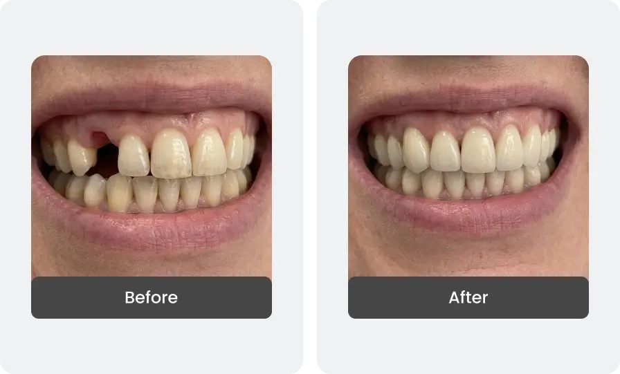 Before and After
