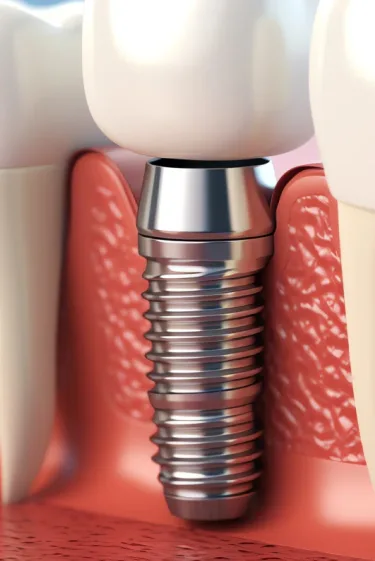 Dental Implants