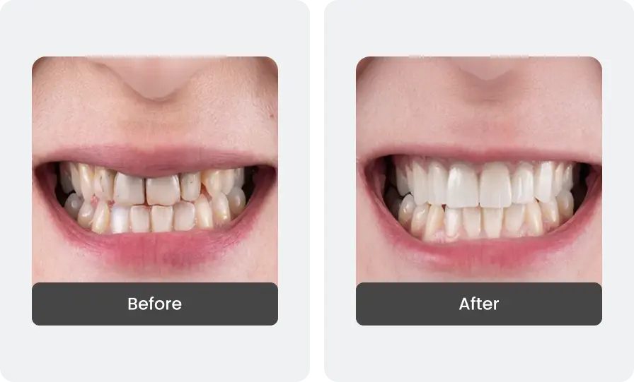 Before and After