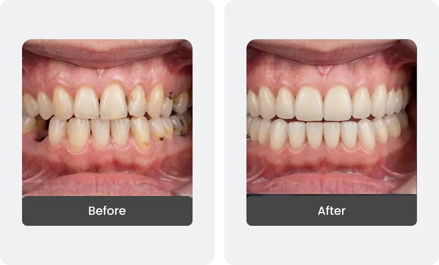 Before and After