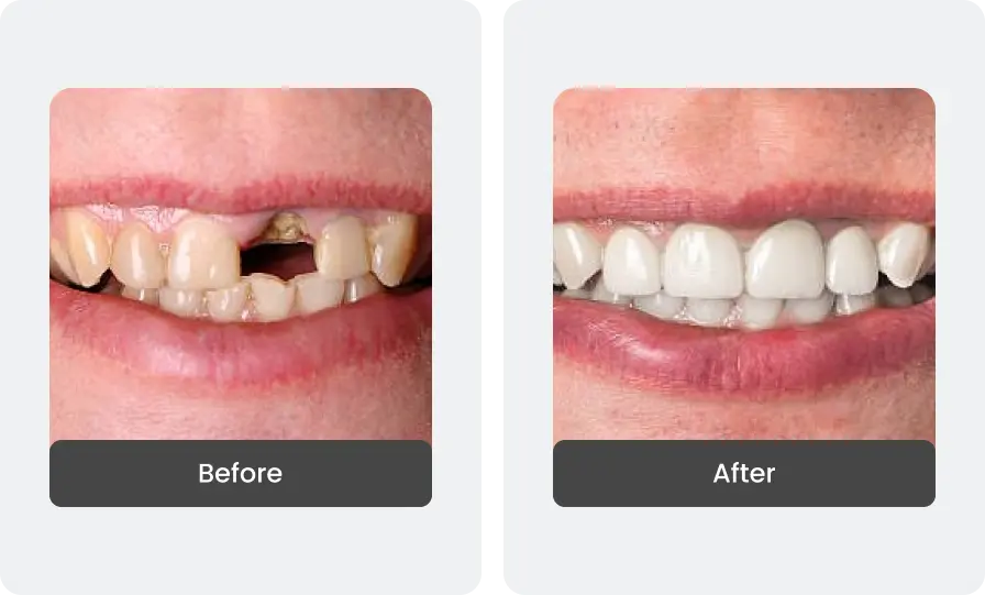 Before and After