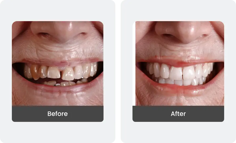 Before and After