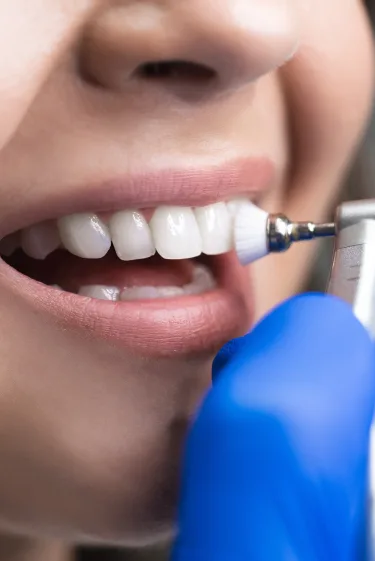 Teeth Cleaning