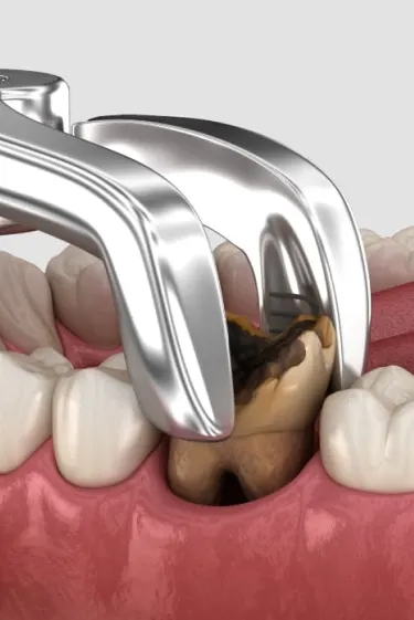Tooth Extraction