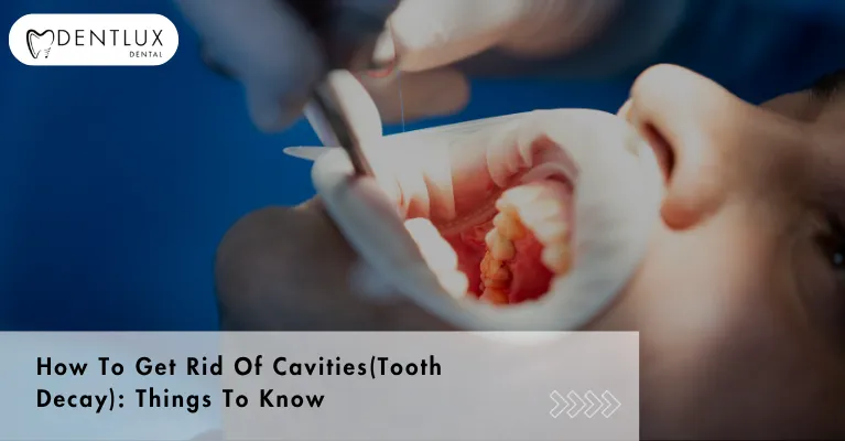 How To Get Rid Of Cavities(Tooth Decay): Things To Know
