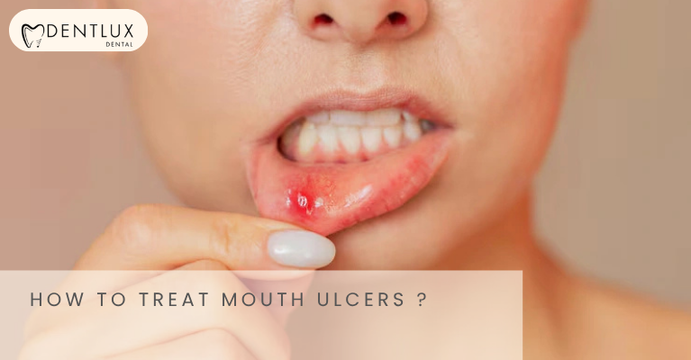 Mouth Ulcer